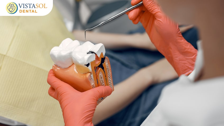 Root Canal Therapy Explained: Separating Myths from Facts