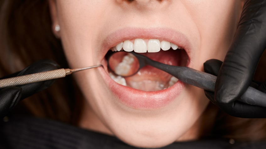 Dental Implants Montebello: Protecting Your Teeth from Decay