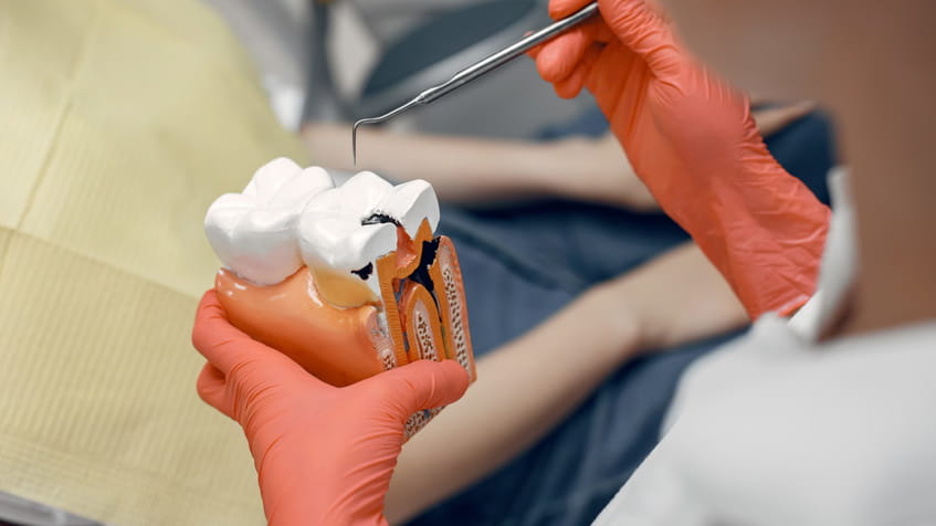 Why Cavities Are Increasing in Adults, Not Just Children