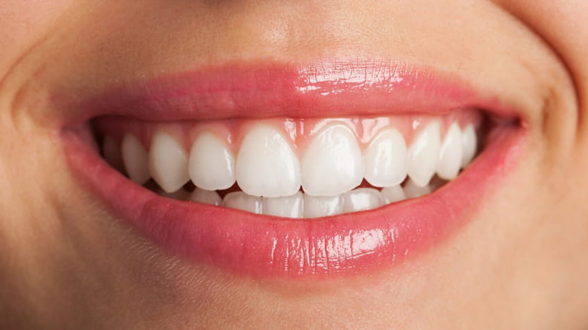 How Long Does Professional Teeth Whitening Last?