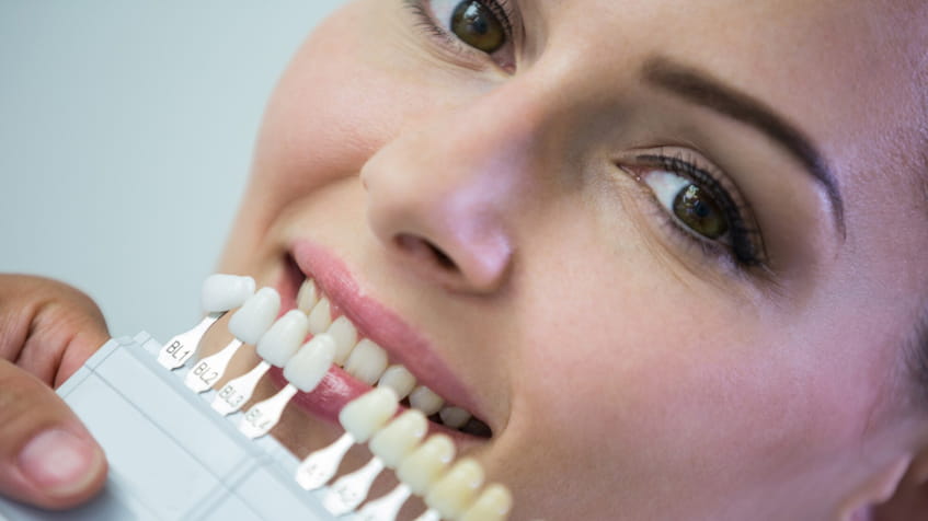 What to Ask a Dentist Before Getting Teeth Whitening